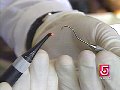 Dental Laser